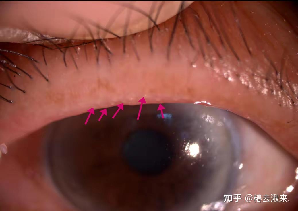 睑板腺堵塞及处理 - 知乎
