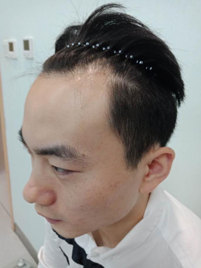 武汉和西安毛囊植发手术的费用是多少1500单位毛囊植发价格贵吗怎么