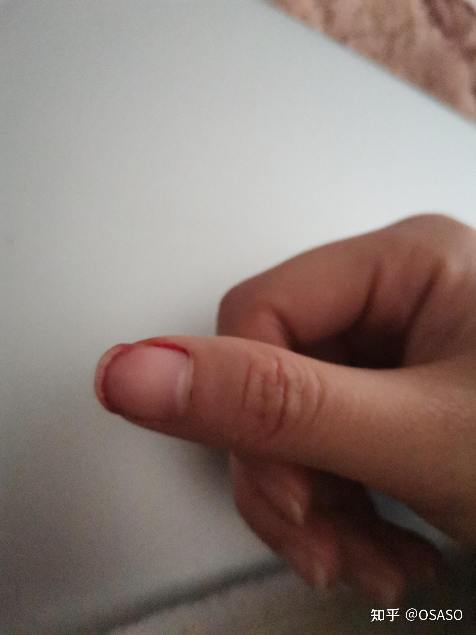 指甲为什么莫名其妙会流血