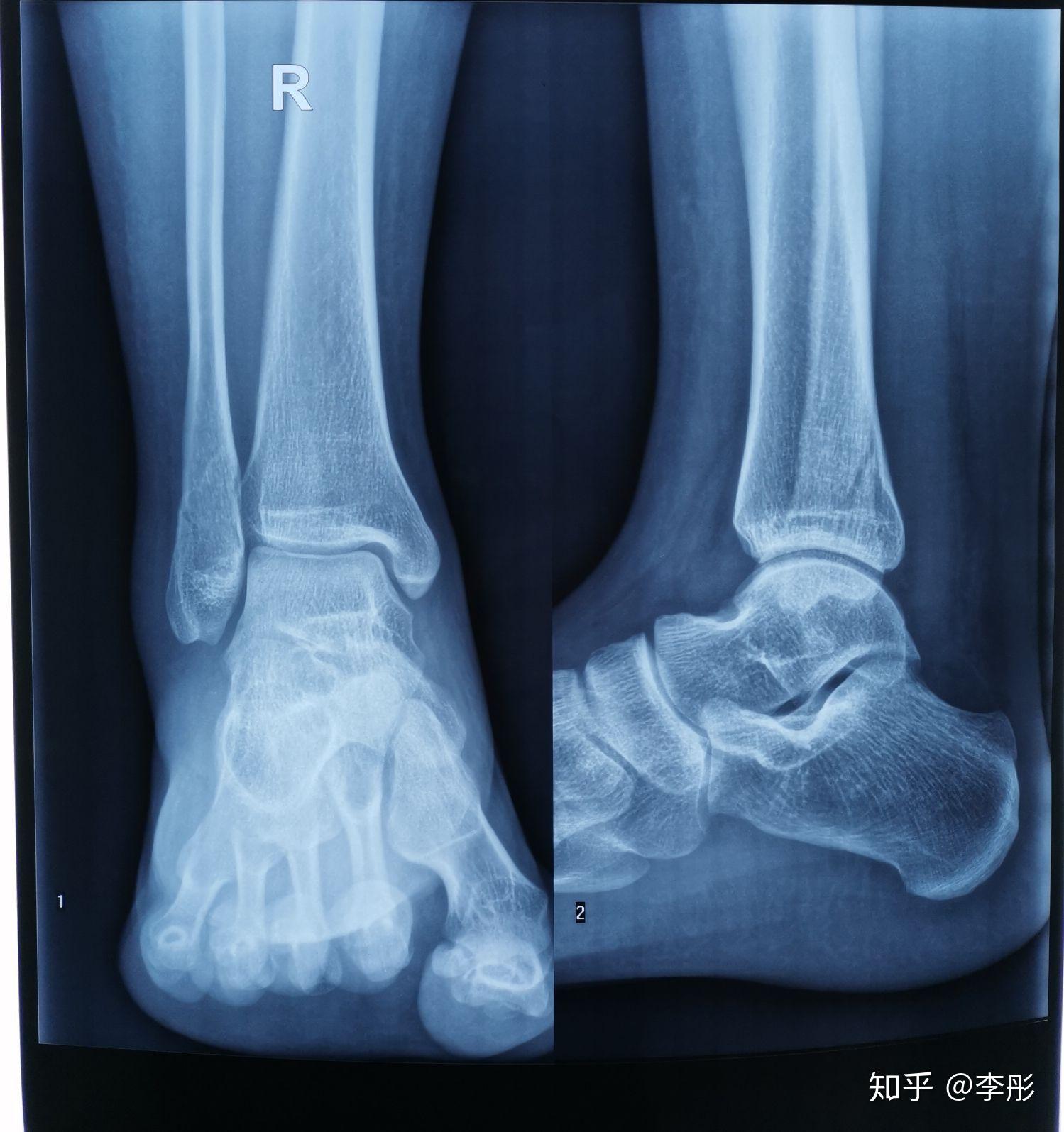 骨折线明显能下地走路吗