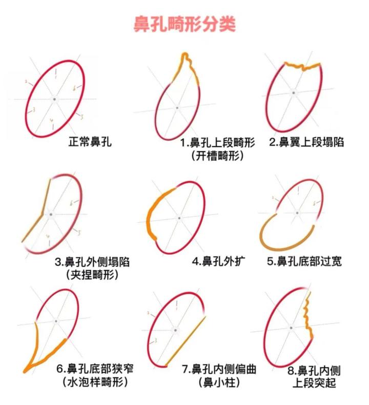 鼻孔常见畸形分类及治疗、预防原则 - 知乎