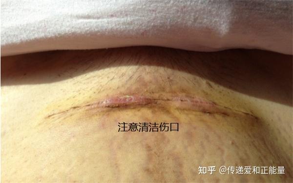 第二次剖腹产是不是在原来的刀口上 - 知乎