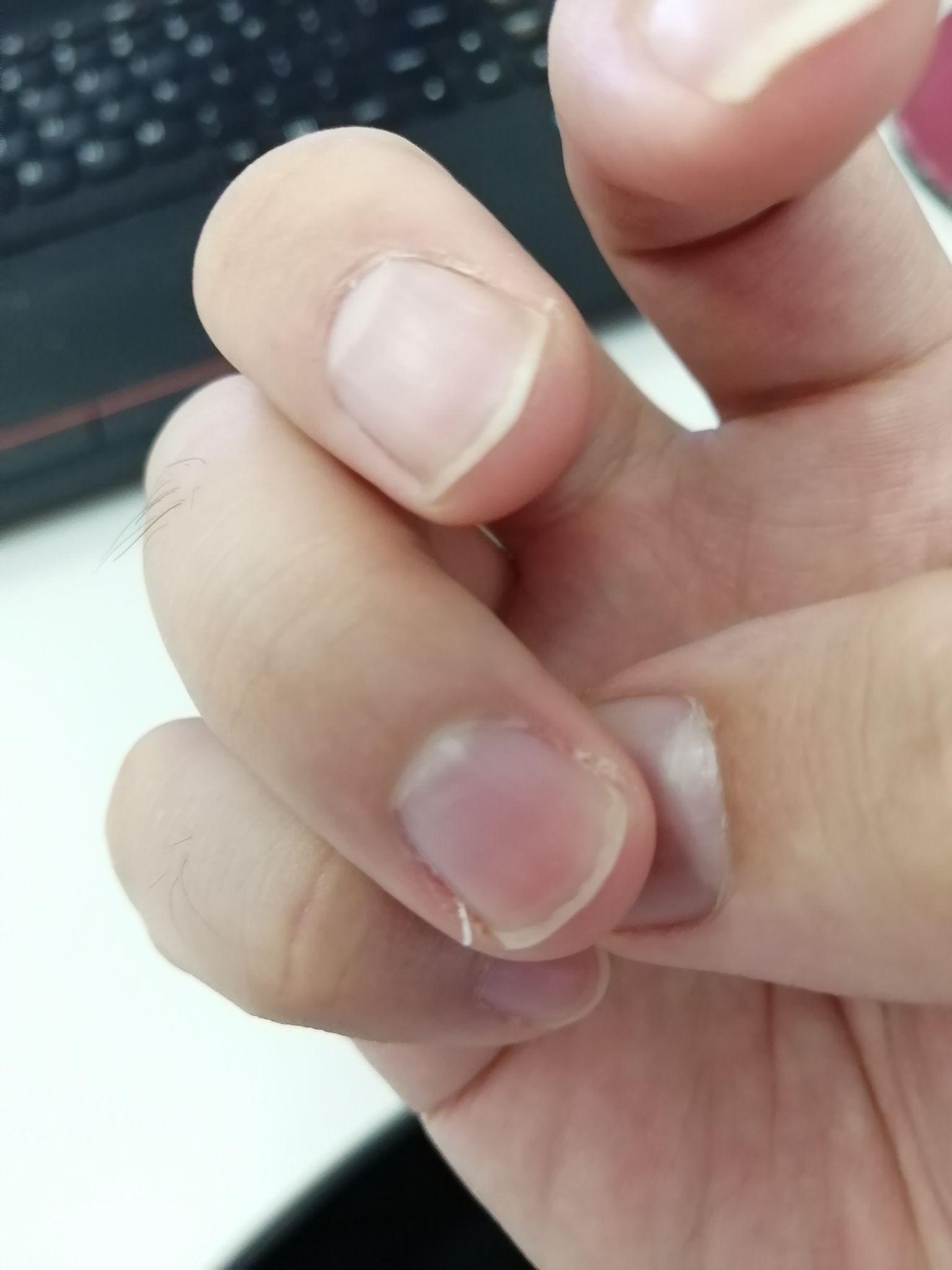 指甲长了侧边分出来的小细条是怎么回事