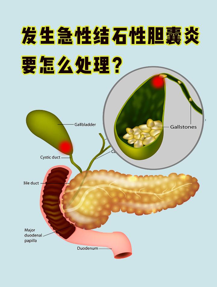 发生急性结石性胆囊炎,要怎么处理? - 知乎