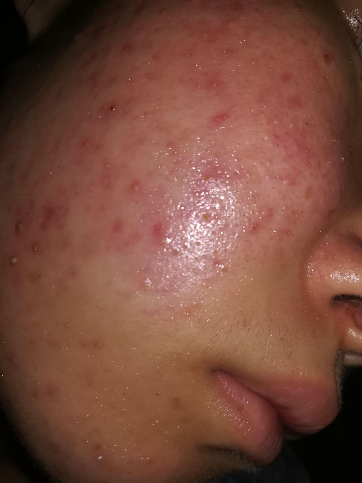 皮炎是什么样症状?