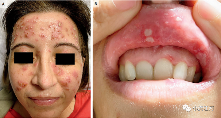 看图识病77|白塞病丘疹脓疱性皮疹