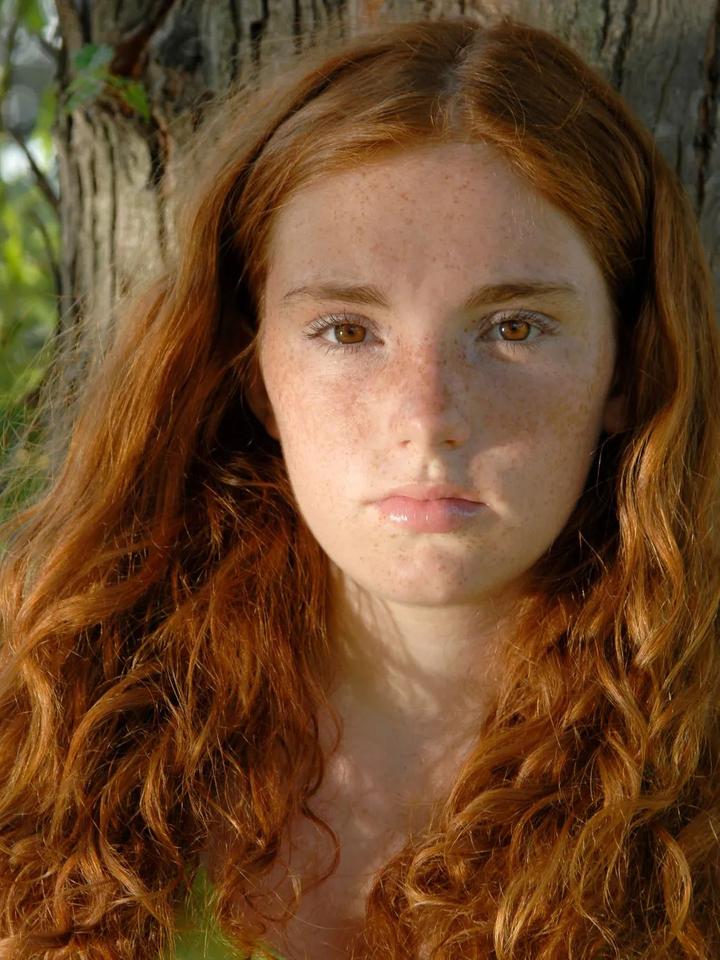 整合治疗,彻底改善黄褐斑 知乎