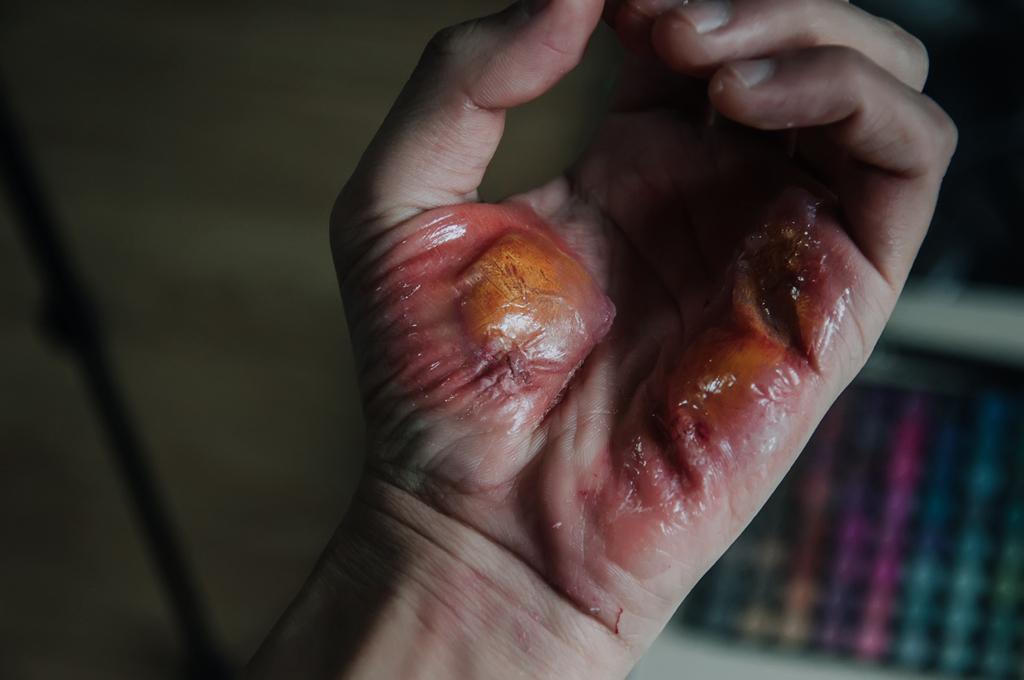 需要什么样的药物化学物质能在皮肤上弄出这样的泡