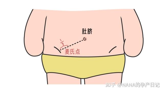 10岁左右的小女孩腹痛4天,医生没发现阑尾炎发现导致
