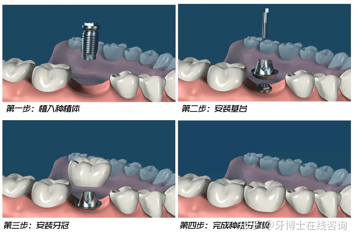 成都种植牙行业新趋势：为牙齿健康护航