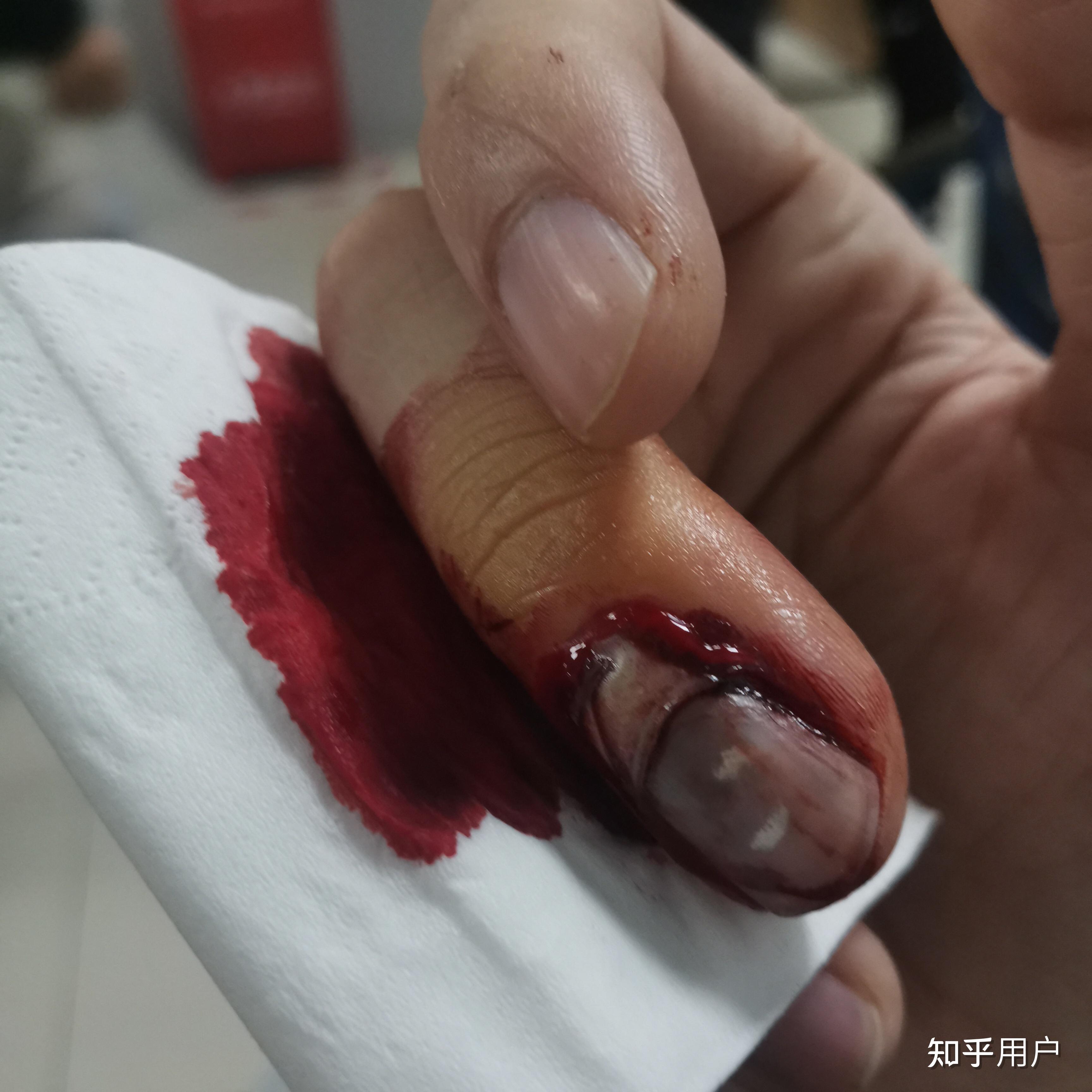 拔指甲是什么样的体验?很疼么?