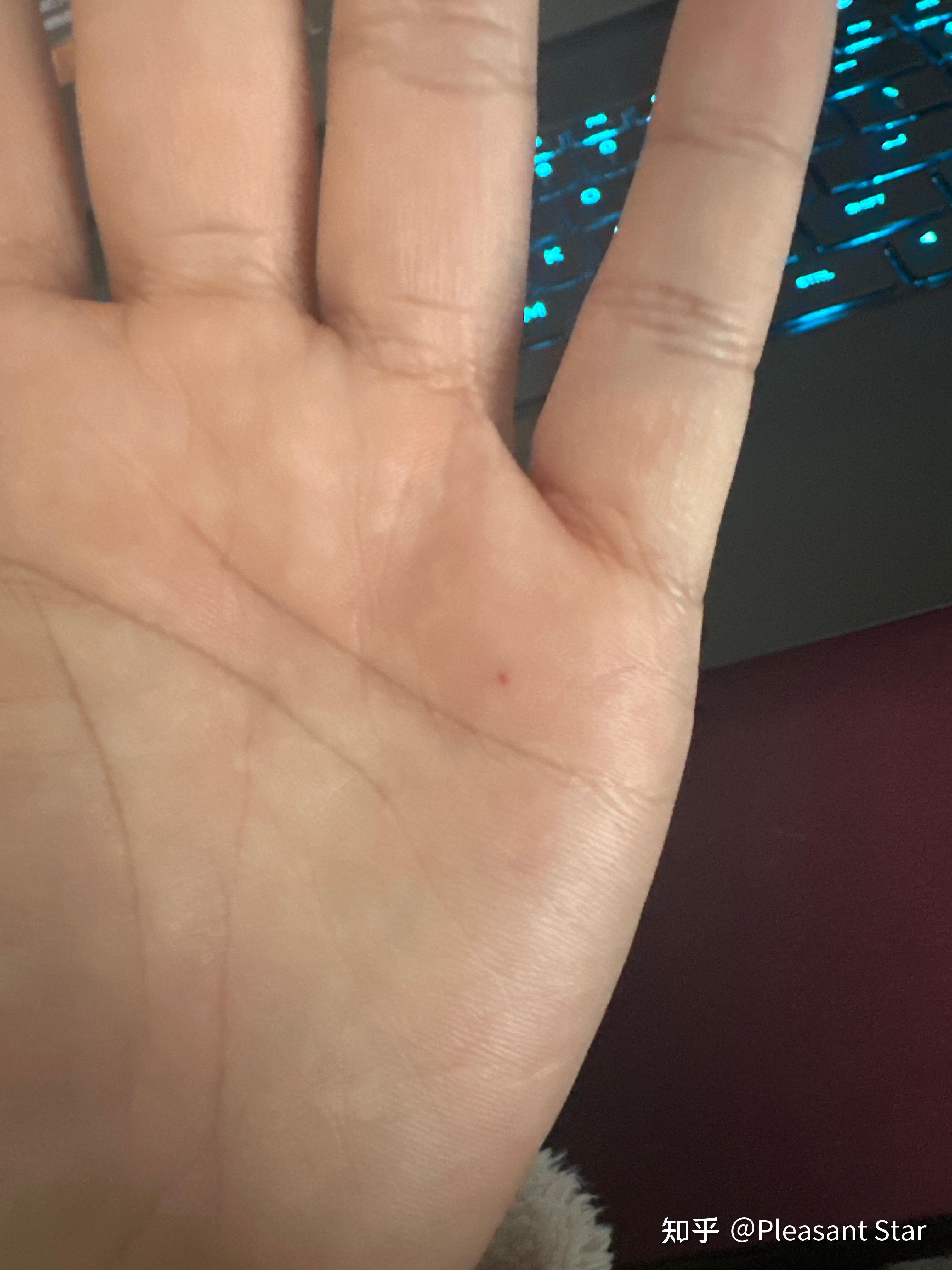 手掌之间有红点是什么情况,目前不痛不痒?