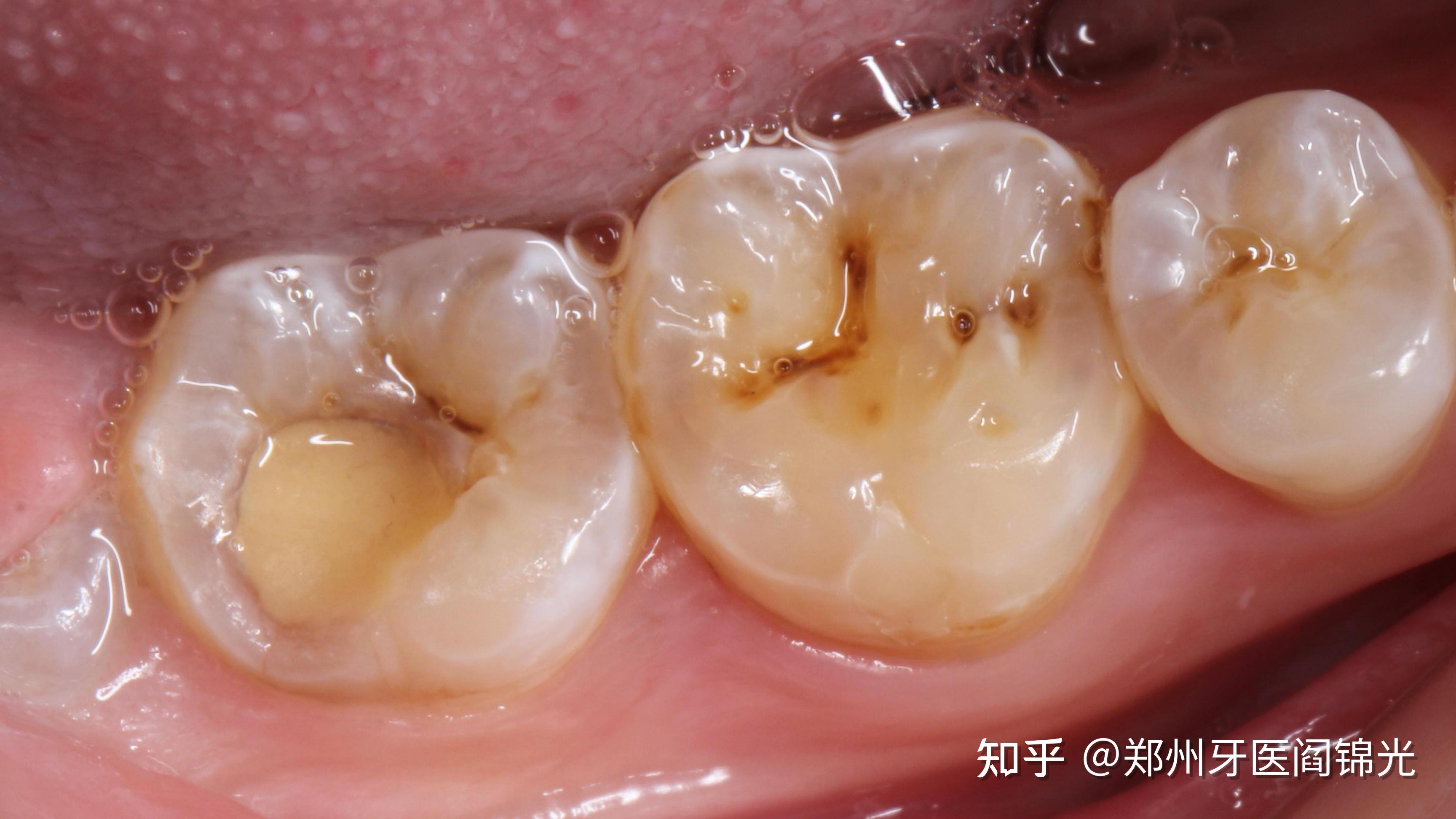 想问一下你们补过的牙坚持了多长时间,补过多少次了? - 知乎
