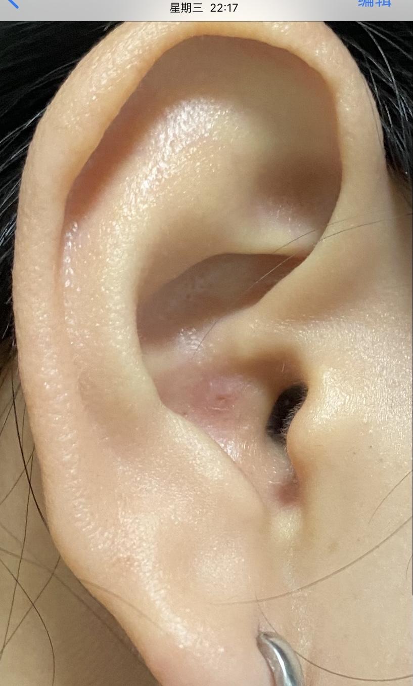 怎样对付外耳道的疖肿