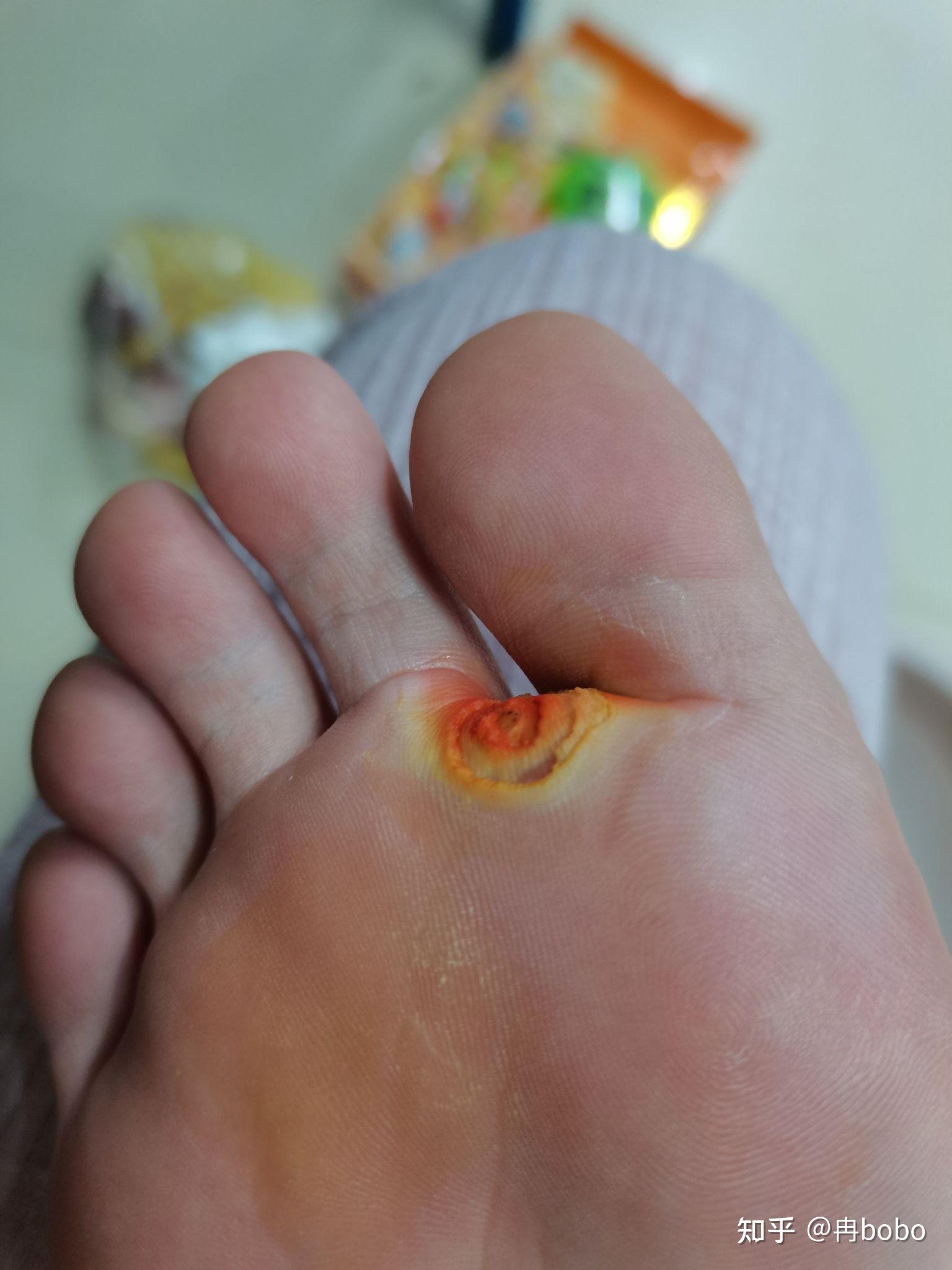 室友挖鸡眼是一种怎样的体验? - 知乎