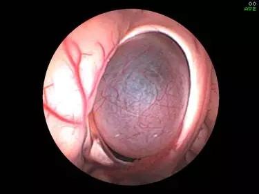 怎么治疗蛛网膜囊肿