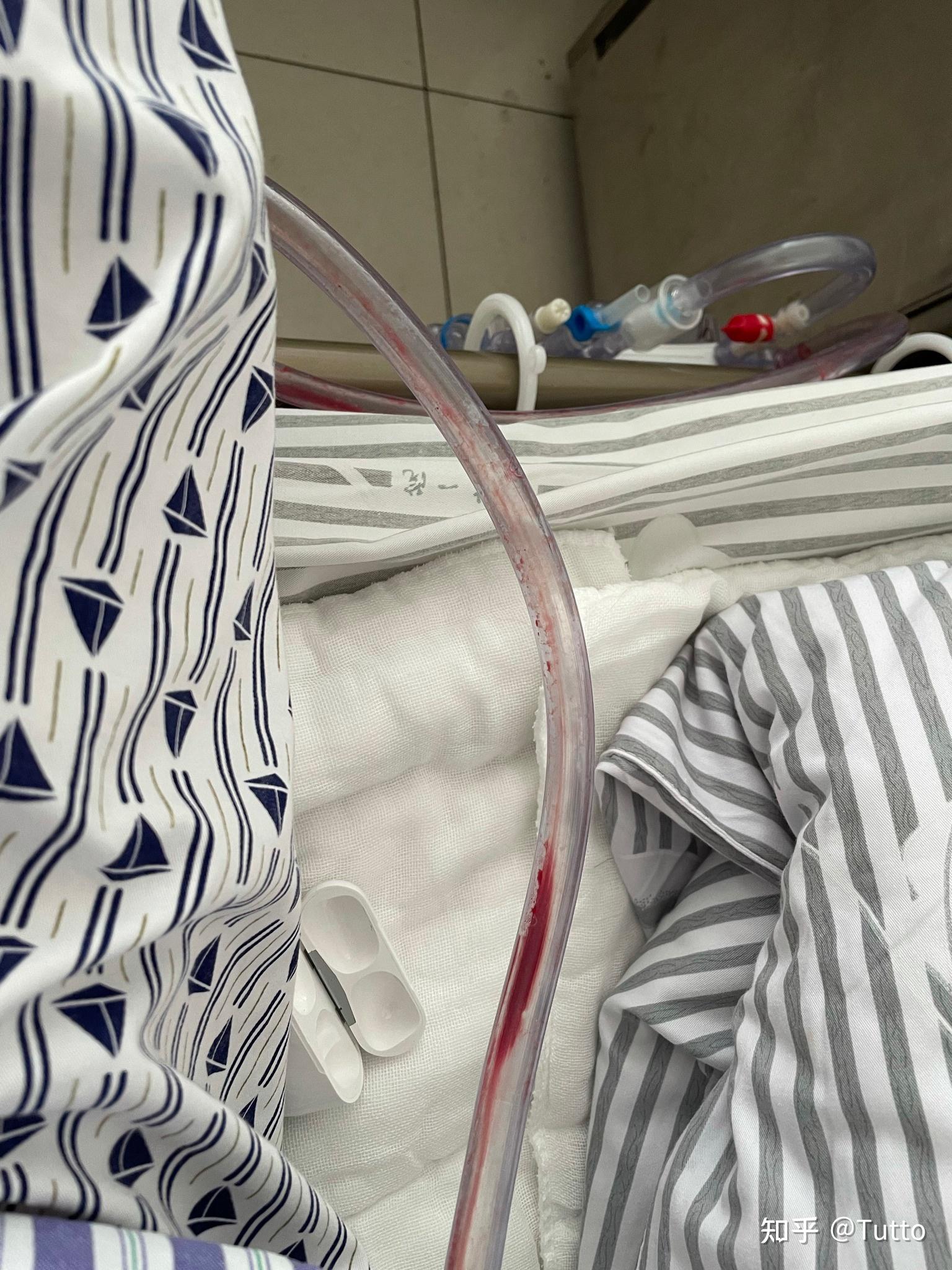 气胸的闭式引流术拔管时候疼吗? - 知乎