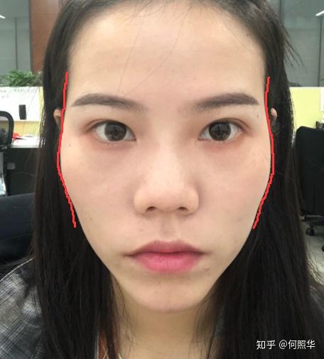 我的颧骨突出吗还是只有太阳穴凹陷附图