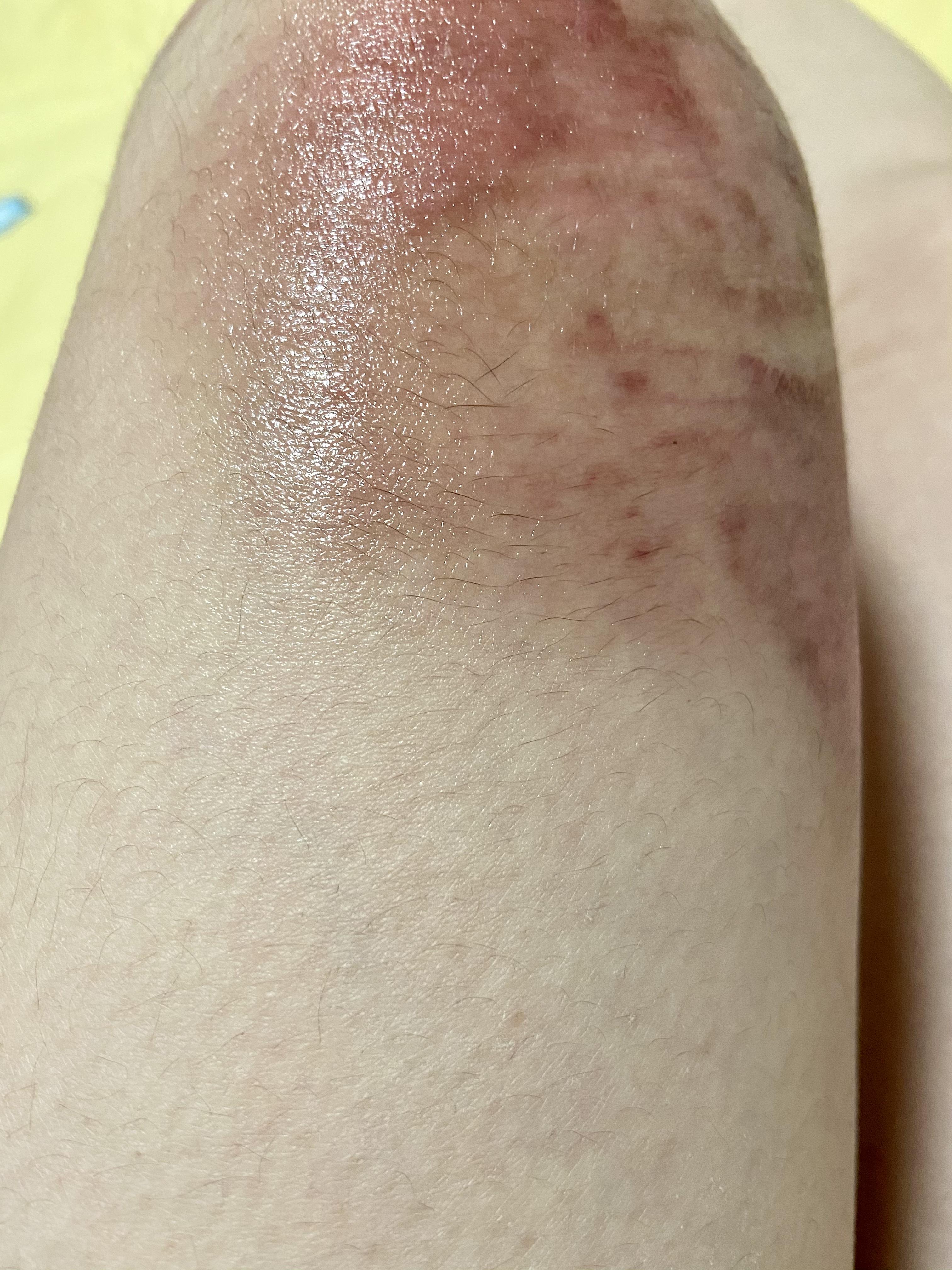 膝盖摔伤抹了碘伏结痂后如何防止留疤