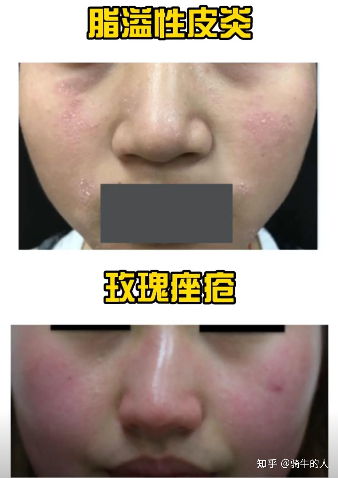 怎么区别溢脂性皮炎和玫瑰痤疮? - 知乎