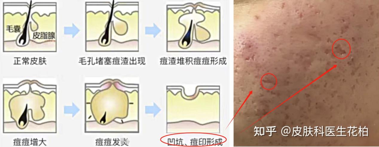 囊肿型痘痘怎么办?脸上囊肿型痘痘摸起来硬硬的,碰一下就疼,怎么样才能快速解决?皮肤科医生教你最有效的祛痘方法,1个月还原光滑健康皮!