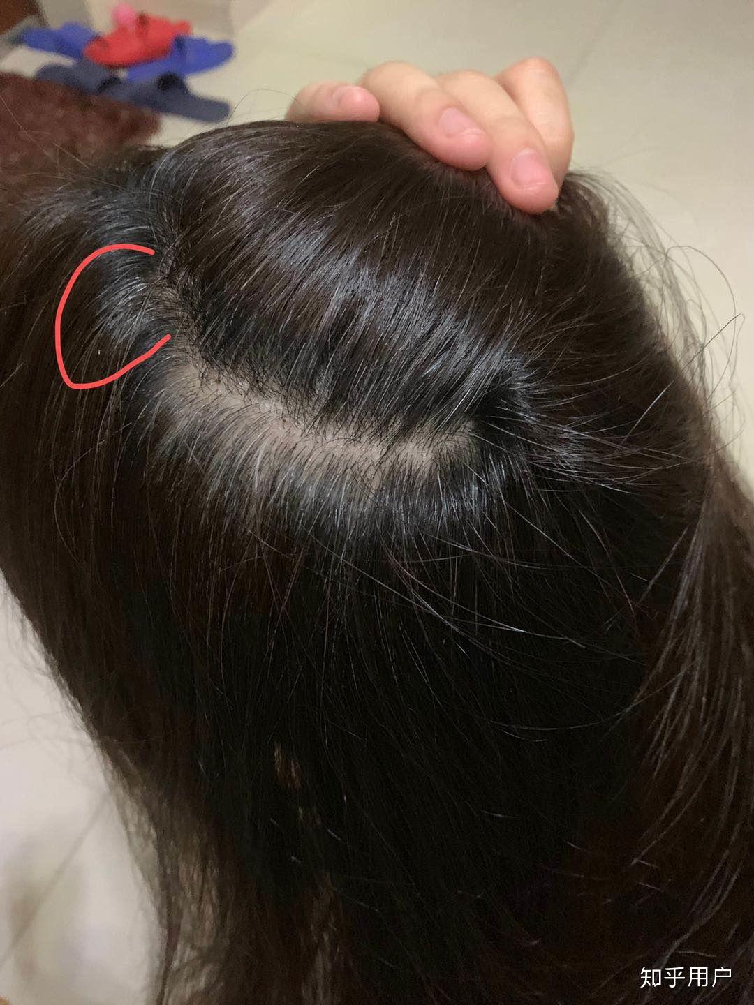 前几年头顶发现长了几根白头发,最近发现白头发特别多了,不染发,有