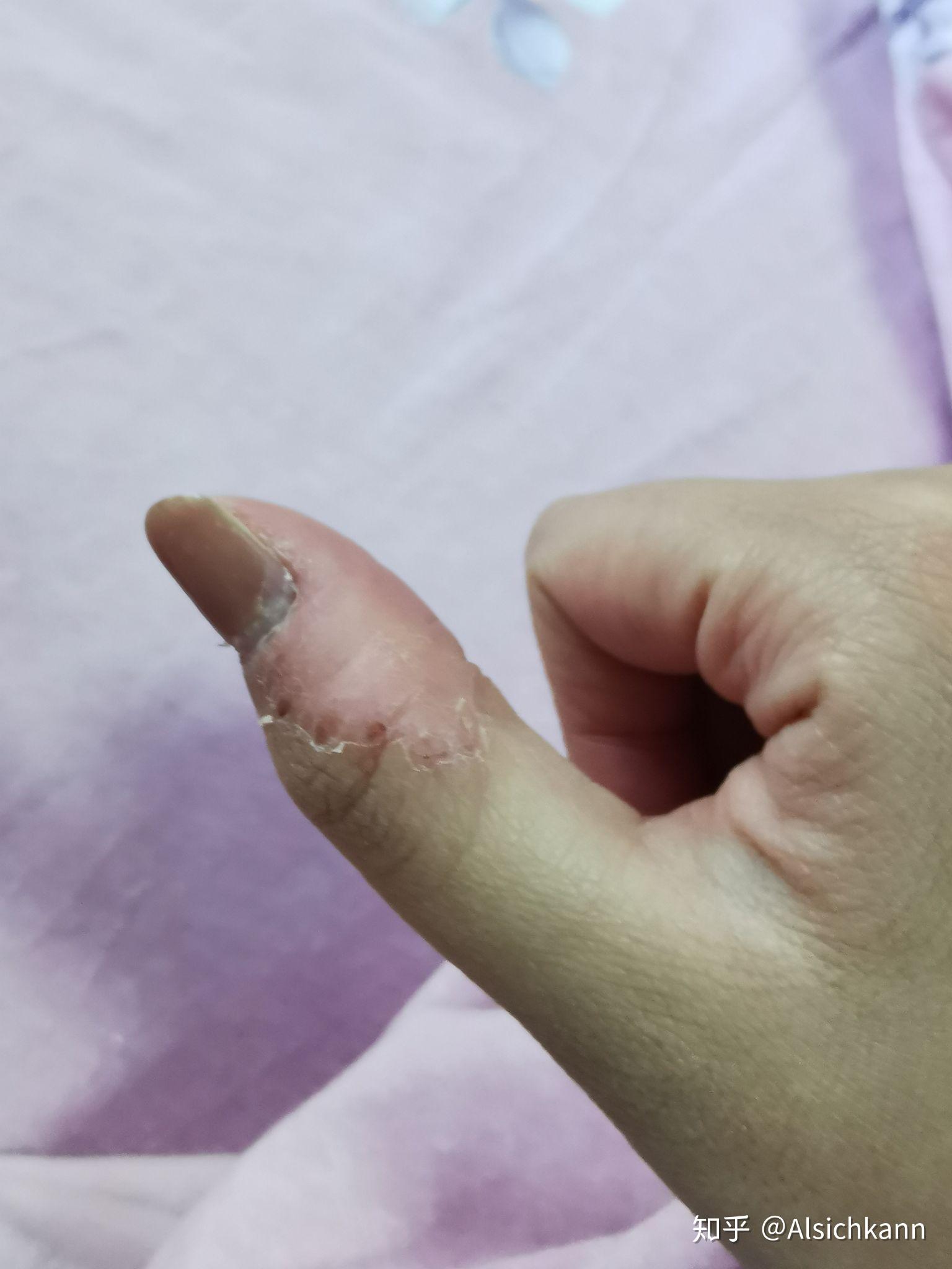 强迫性皮肤剥离症是什么