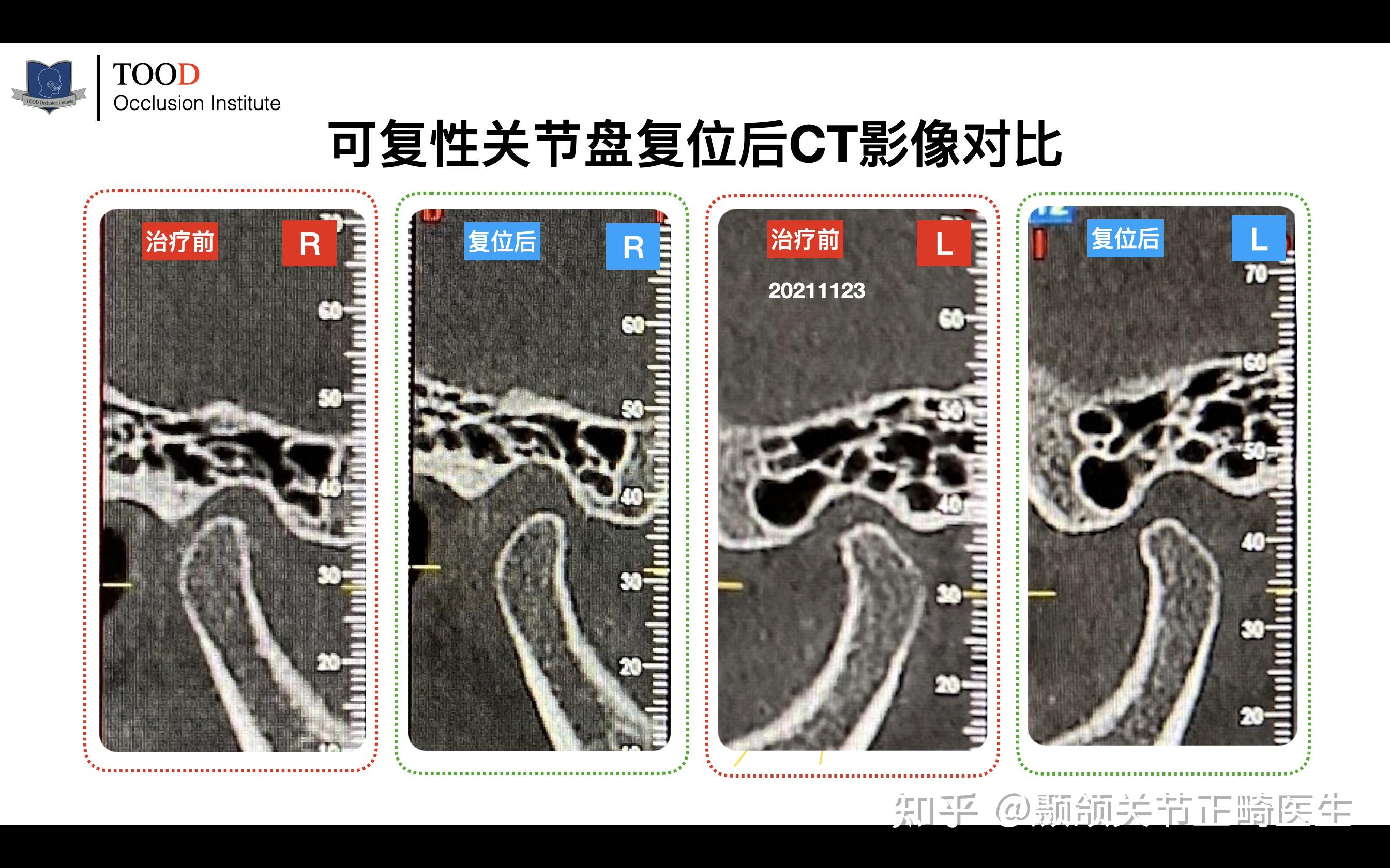 颞颌关节张口位图片