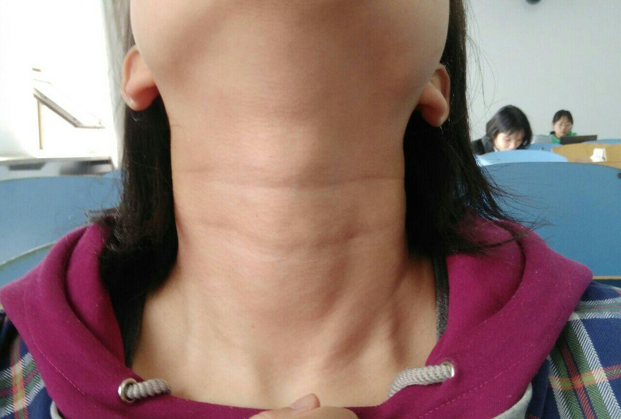 为什么有人天生有两道颈纹