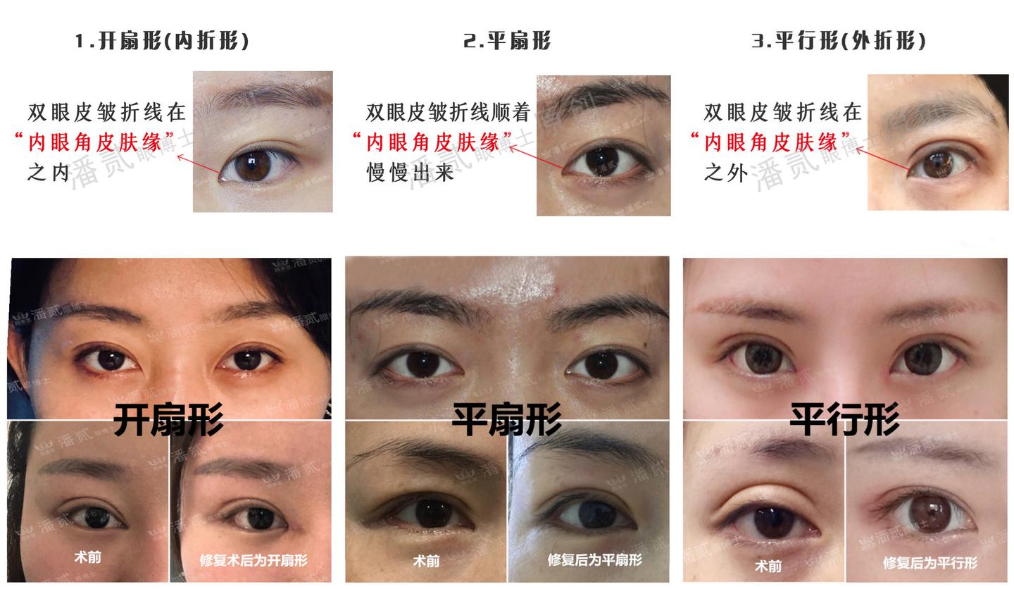 割双眼皮或双眼皮修复 怎么才能找到靠谱的整形医生 知乎 割双眼皮或双眼皮修复 怎么才能找到靠谱的整形医生 知乎