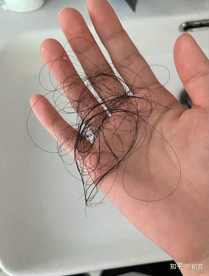 女生发量少头顶快秃了有没有什么好的生发方法跪求