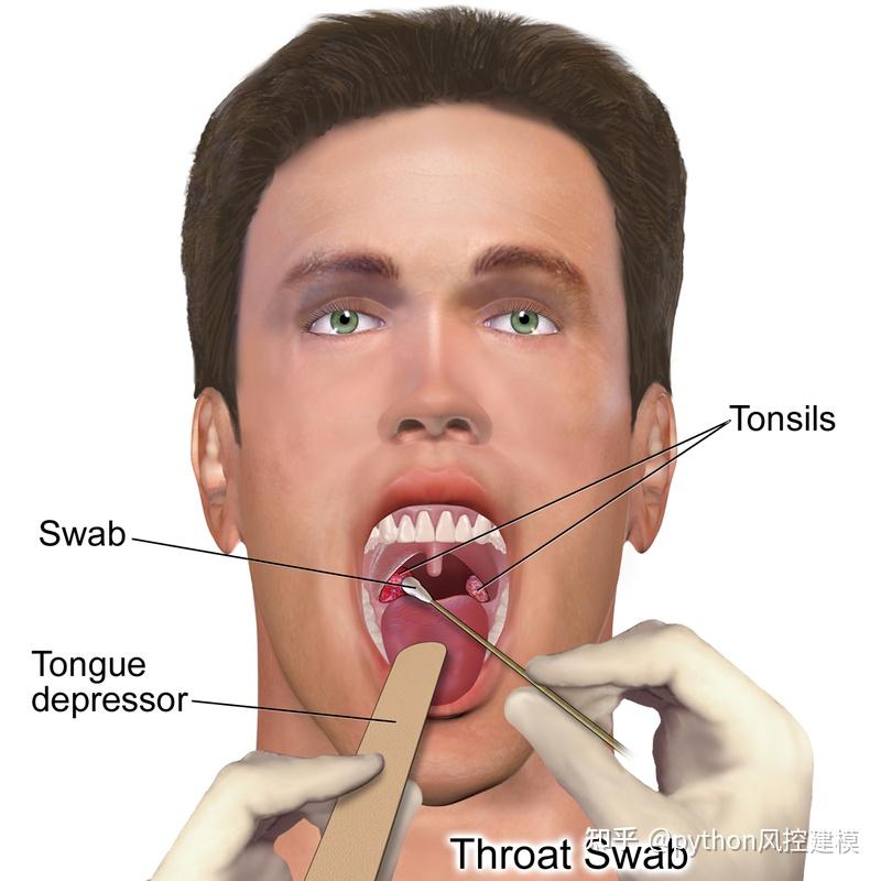 一图读懂慢性咽喉炎Chronic pharyngitis - 知乎