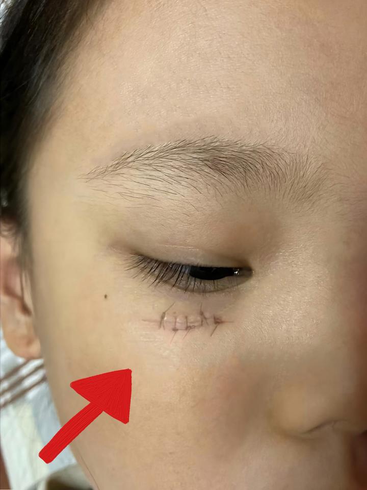 还在因为孩子缝针留疤的一定不要错过这篇文章!