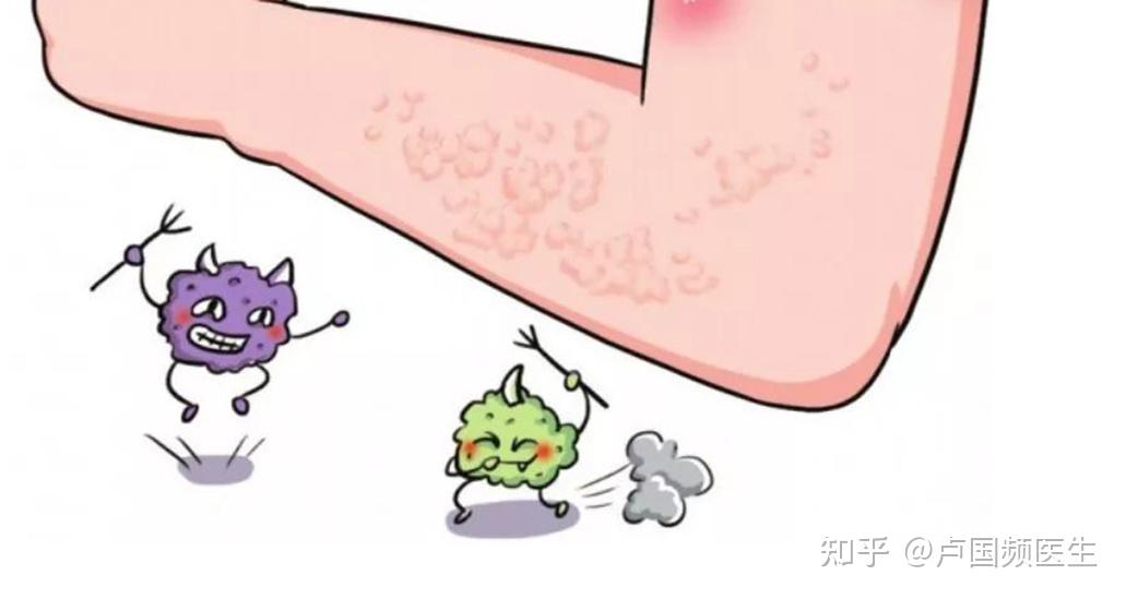 得了湿疹不要慌!医生:5个中医辨证施治方法,想要治愈没那么难 - 知乎