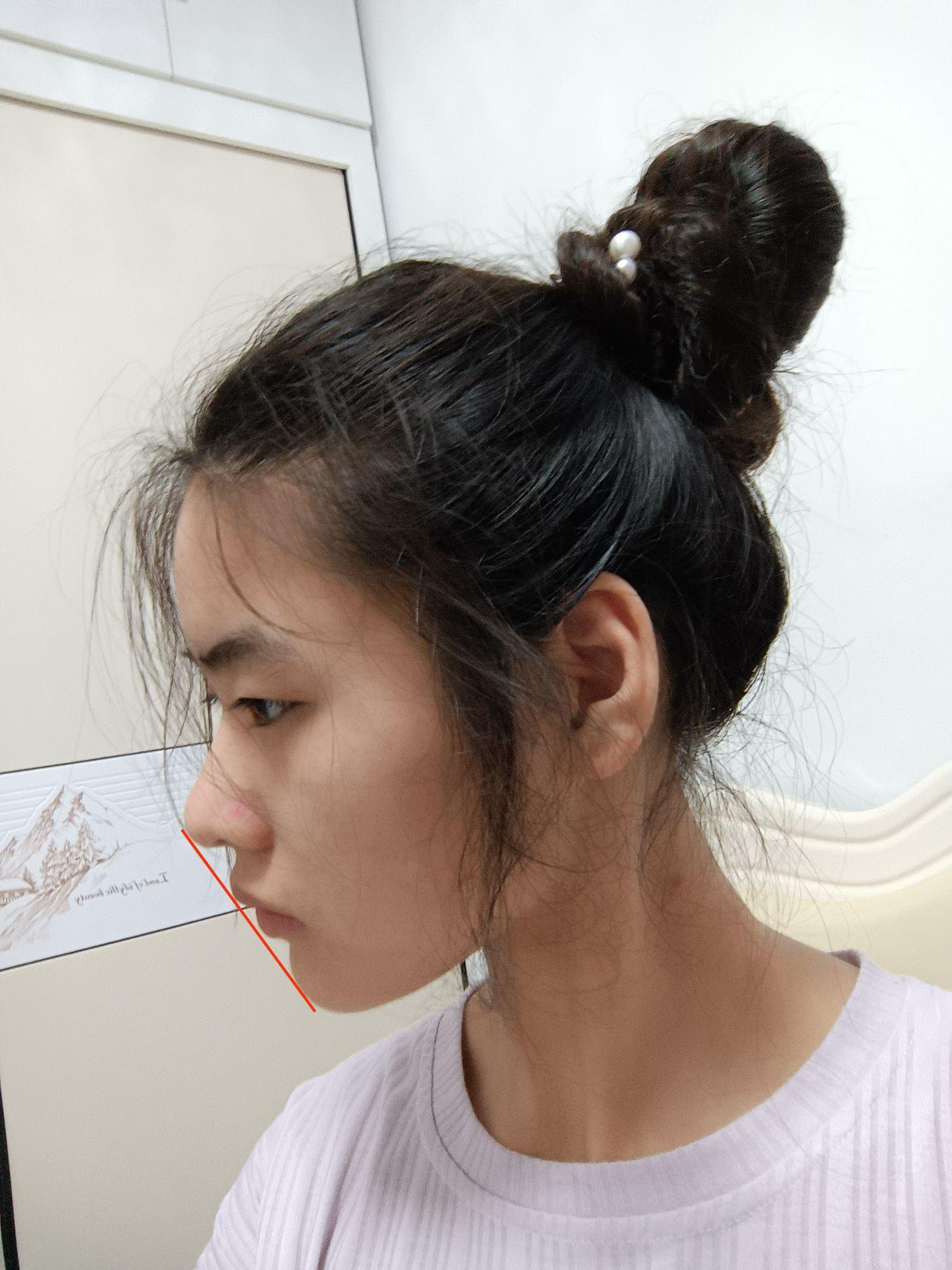 我到底是凸嘴还是人中肉厚? - 知乎