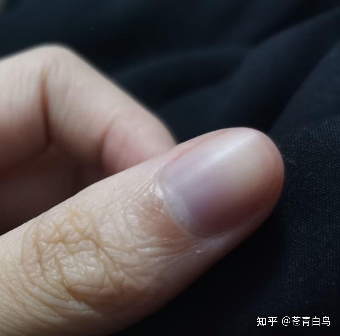 为什么我的指甲会发紫? - 知乎