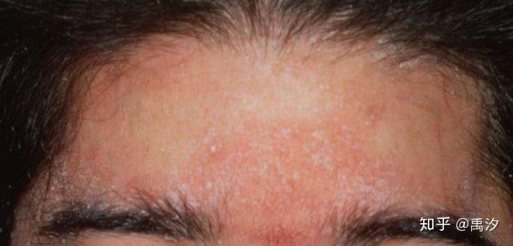 请问头部脂溢性皮炎产生的大块白色片状鳞片到底是什么物质以及诸多