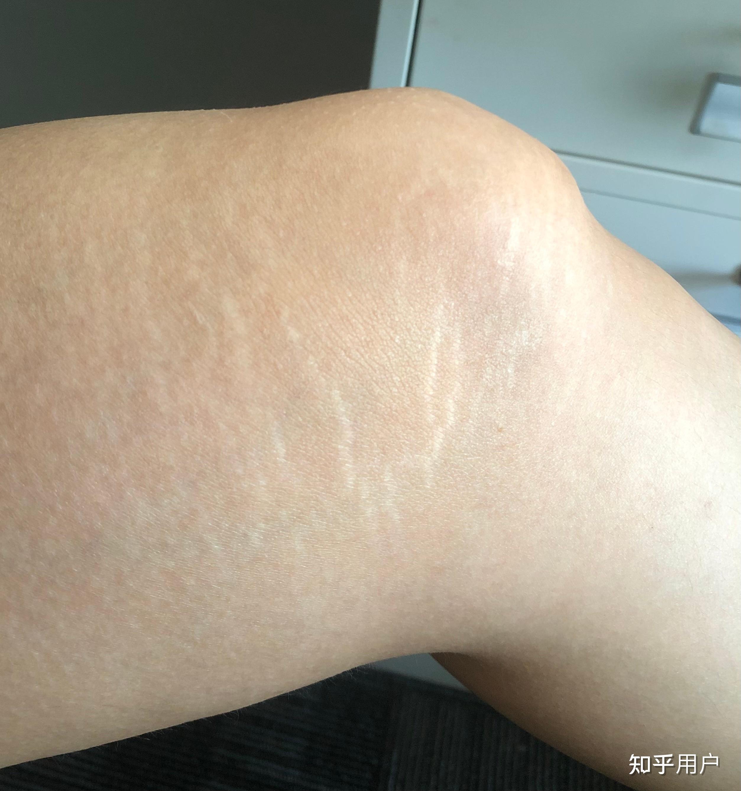 婚前发现老婆大腿上有妊娠纹但她说是因为胖真的吗