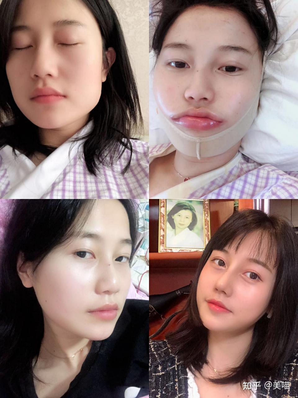 磨腮削骨手术会使脸下垂吗?