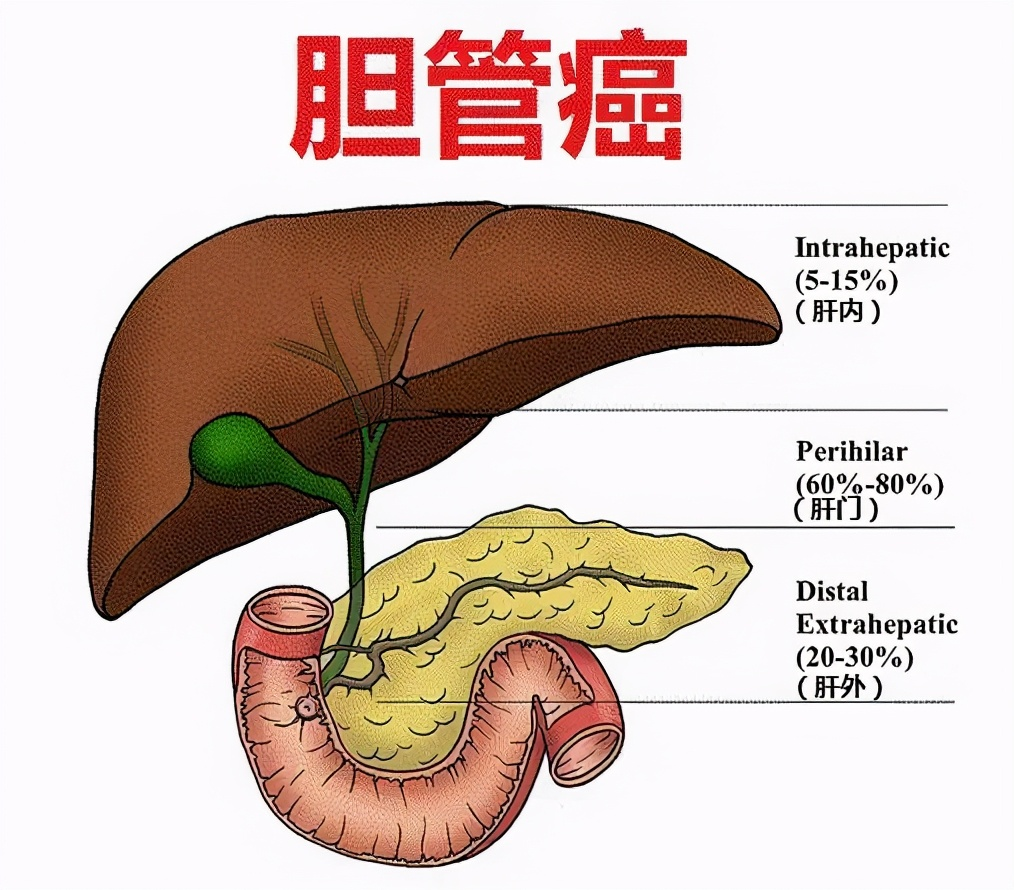 胆管癌最新治疗方案：全身化疗与靶向治疗的有效结合 - 知乎
