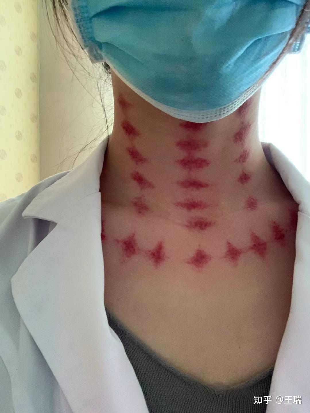 为什么说拔罐拔出来的黑紫色印记是毒素呢? - 知乎