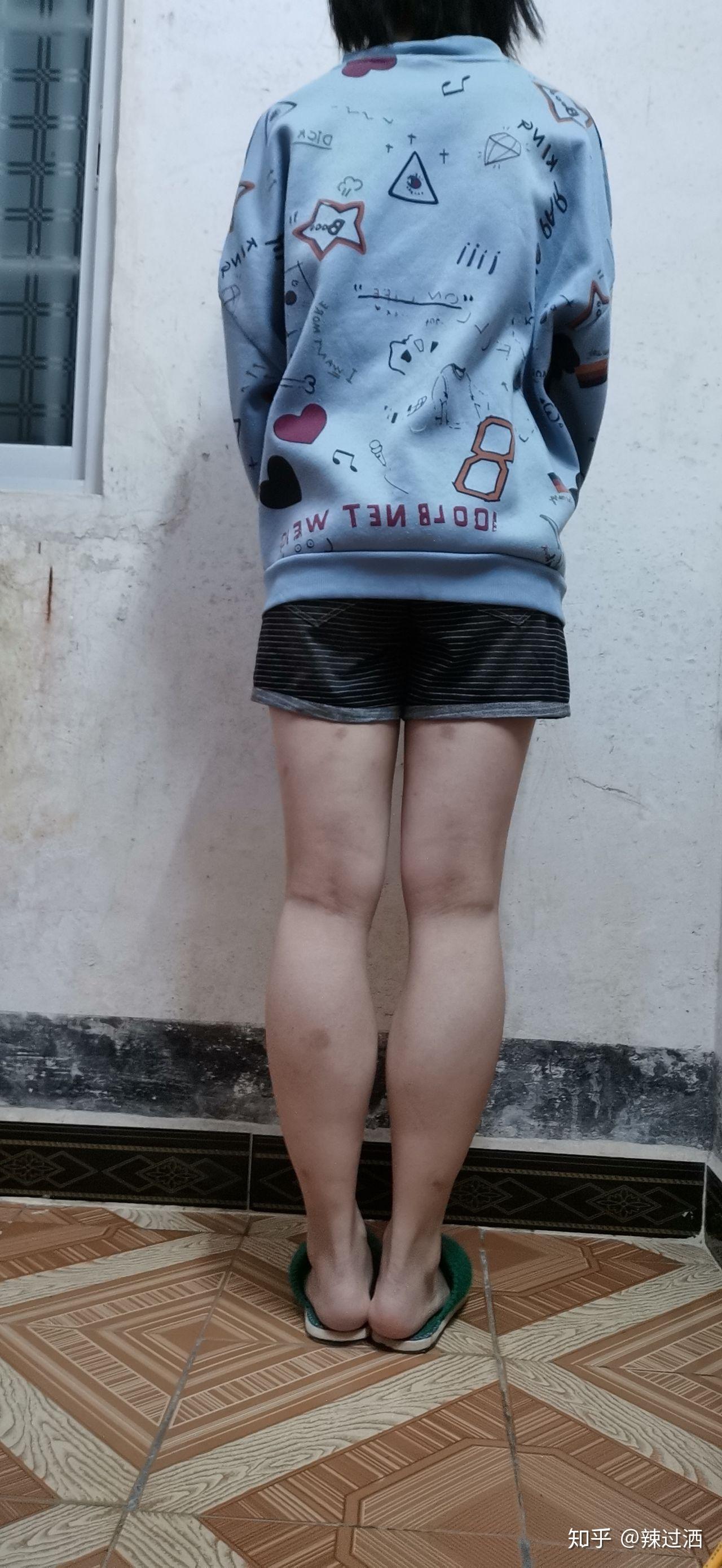 本身就瘦的人但是小腿很粗怎么办