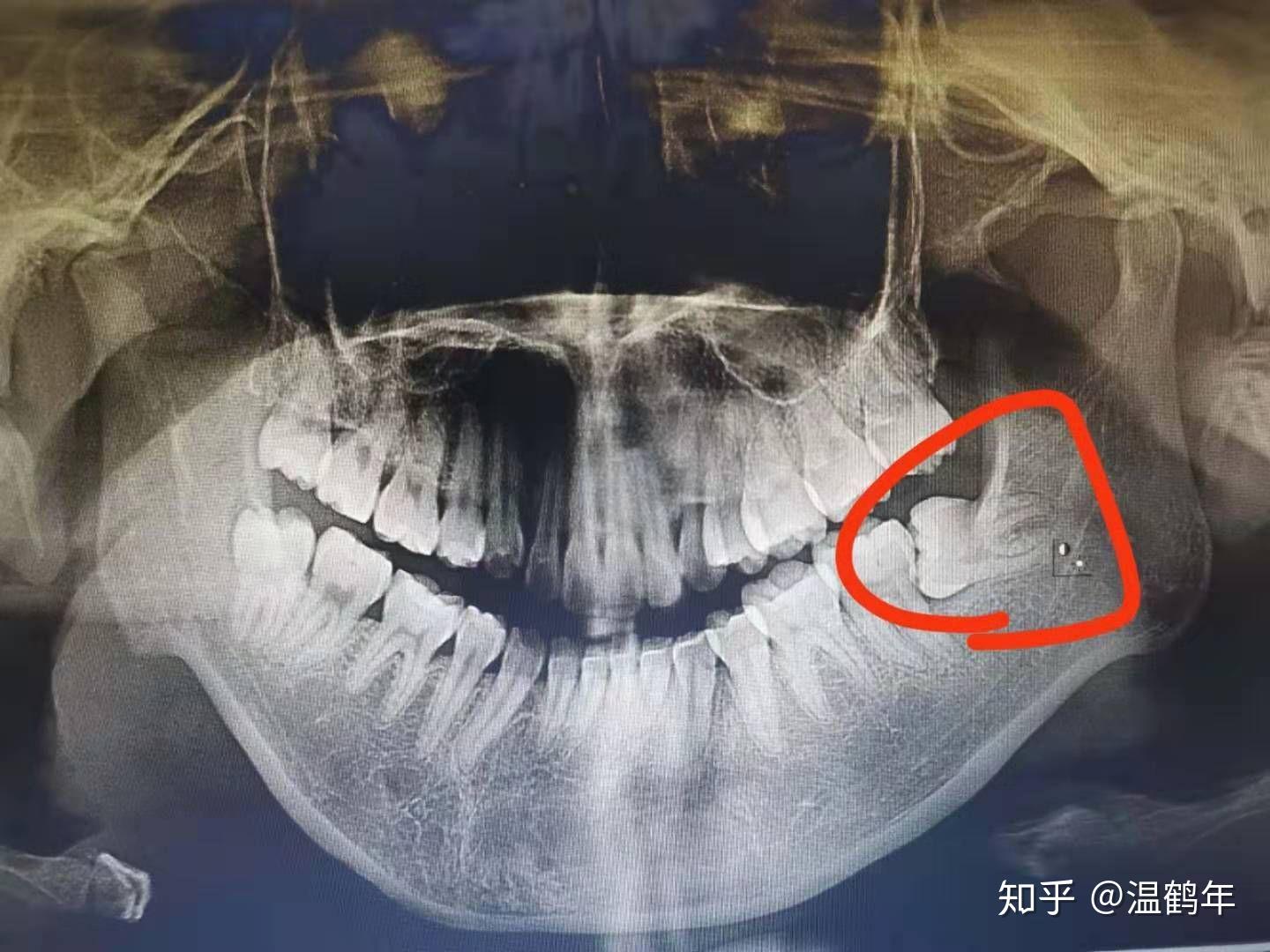 橫生的智齒一定要拔除嗎?