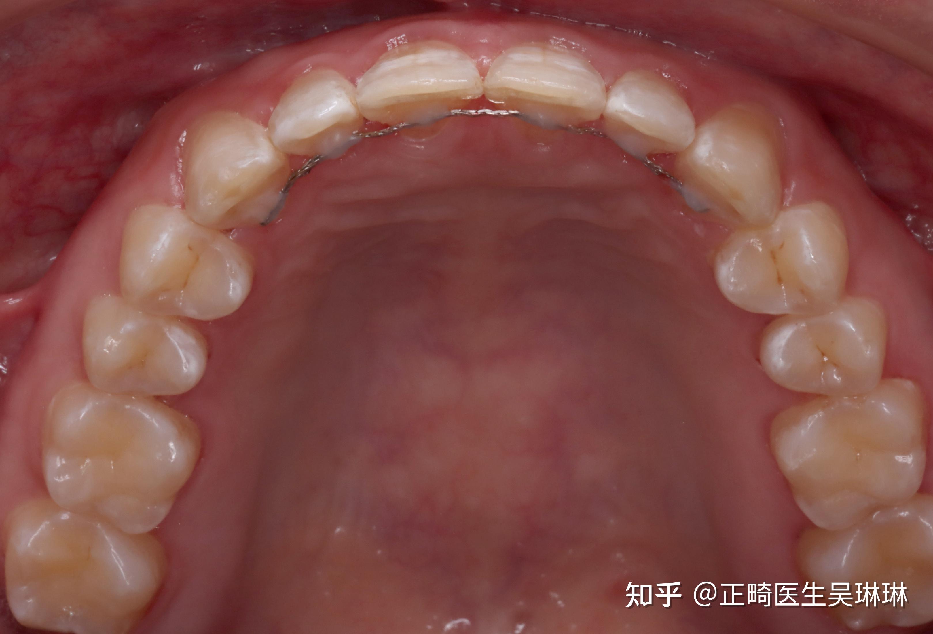 门牙缝隙怎么越来越大? - 知乎