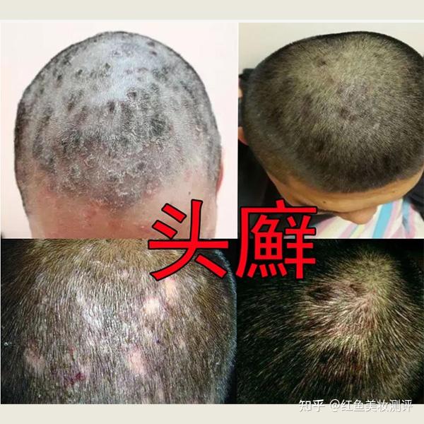 用洗发水头皮起疙瘩怎么回事?? - 知乎