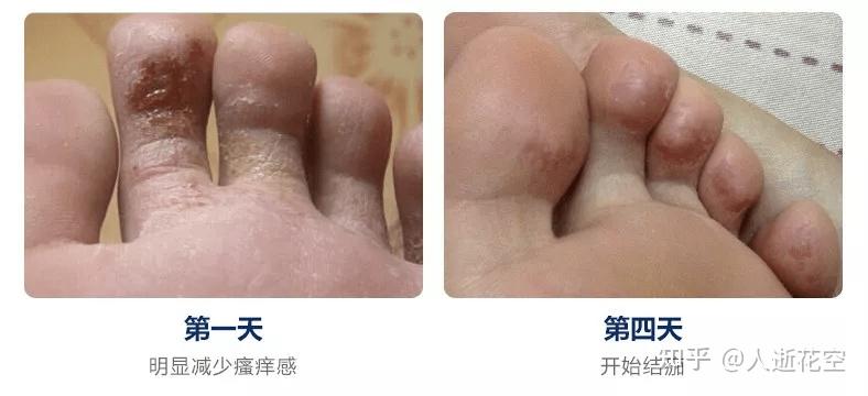 脚痒用什么方法止痒最有效? - 知乎