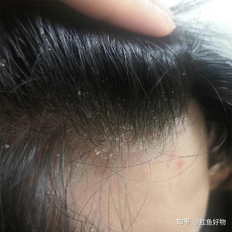 去头痒止头屑洗发水?好用的去屑止痒控油洗发水 - 知乎