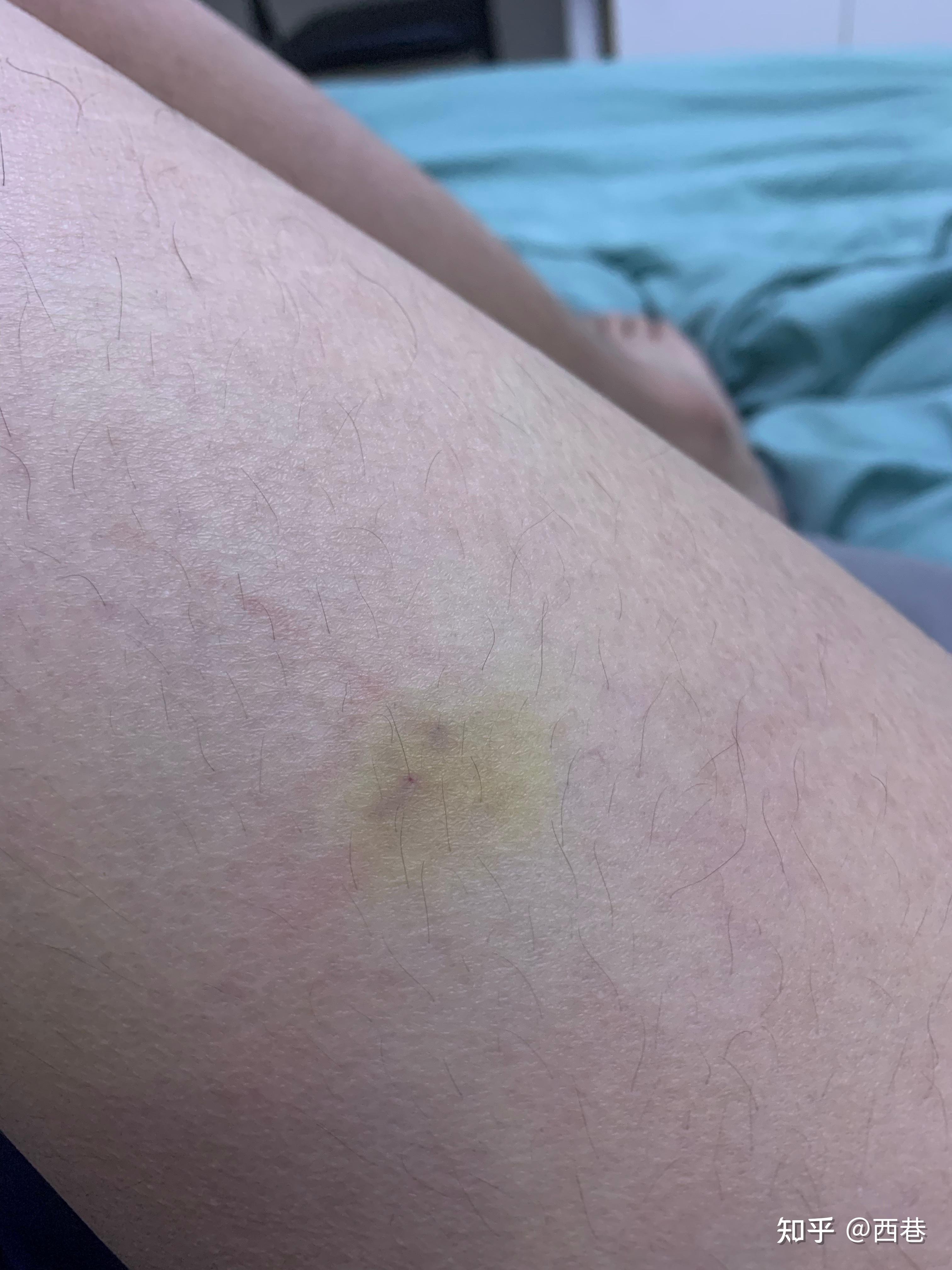 23岁,最近发现腿上长了好几块小的黄色斑点,不疼不痒的,什么情况啊?