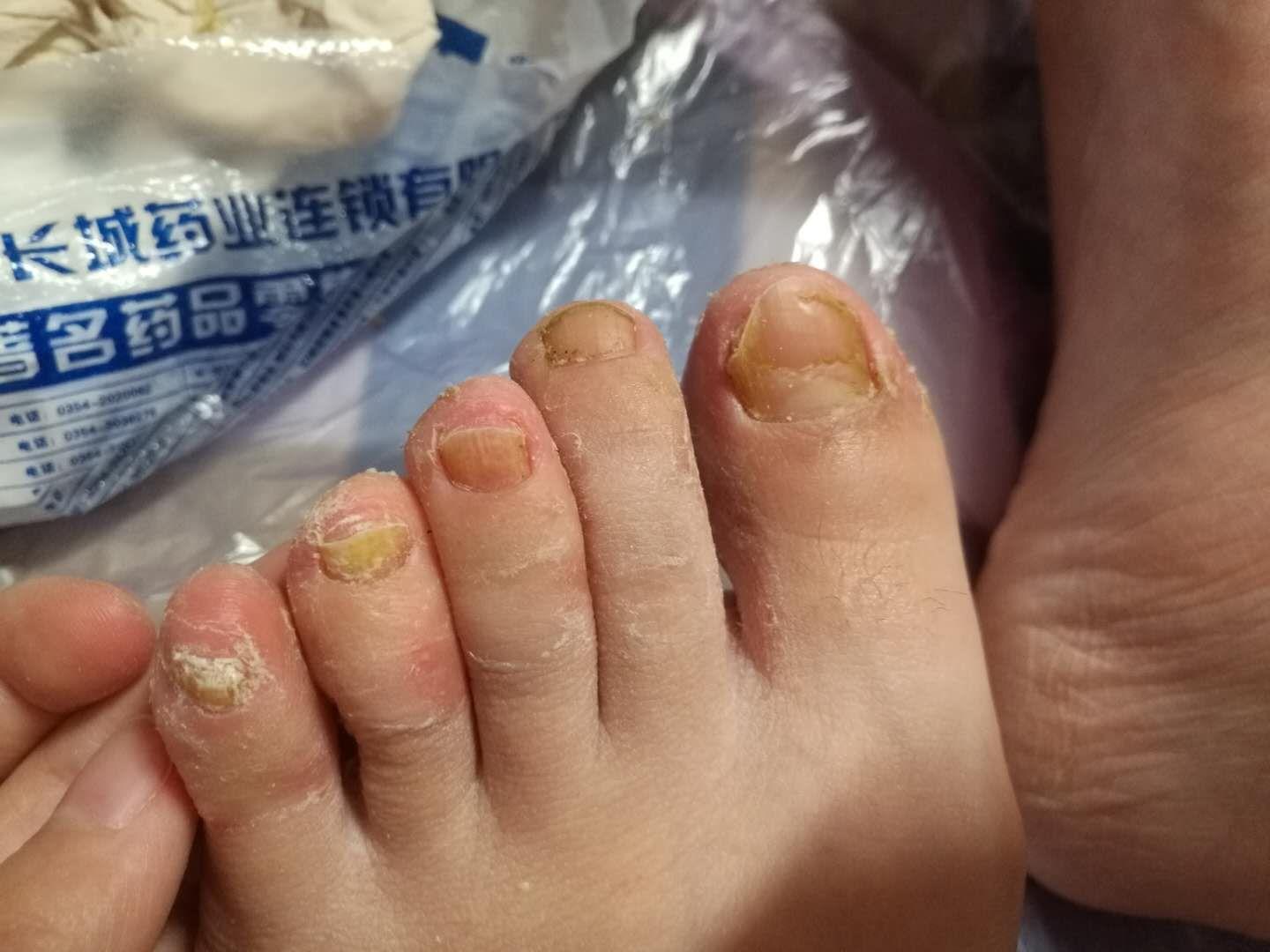 腳趾甲很厚是灰指甲嗎