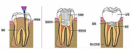 牙齿打桩图片步骤图片